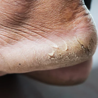 Rachaduras e fissuras nos pés são aberturas na pele que aparecem com frequência nos calcanhares e entre os dedos. Elas surgem principalmente devido ao ressecamento e à falta de hidratação, podendo causar desconforto e até dor.