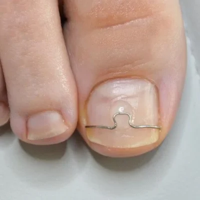 A órteses para correção das unhas são dispositivos utilizados por podólogos e profissionais de saúde para ajudar a tratar e corrigir problemas nas unhas, como unhas encravadas ou deformidades.