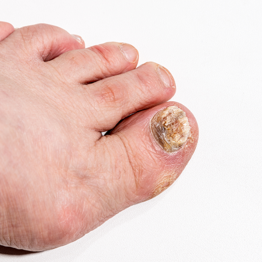 A micose na unha, chamada cientificamente de onicomicose, é uma infecção fúngica que atinge as unhas das mãos ou dos pés. Essa condição é bastante comum e pode ser causada por diversos tipos de fungos, como dermatófitos, leveduras e mofos. Geralmente, a infecção ocorre quando esses fungos encontram um ambiente favorável para crescer e se proliferar sob a unha.