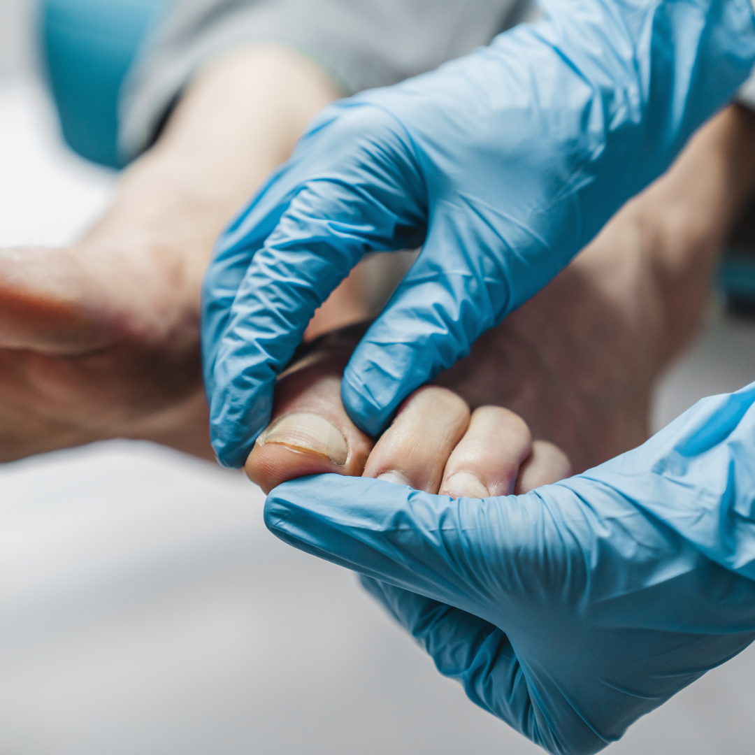 A onicocriptose, popularmente chamada de unha encravada, ocorre quando a borda lateral ou a ponta da unha cresce em direção à pele ao redor do dedo, provocando dor, desconforto, inflamação e, em casos mais graves, infecção. Esse problema pode afetar qualquer dedo do pé, embora seja mais frequente nos dedões. As principais causas incluem o corte inadequado das unhas, o uso de sapatos apertados, traumas na unha e fatores genéticos.